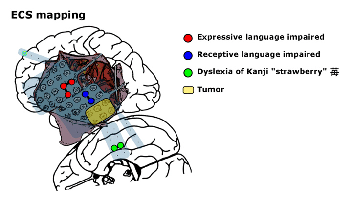 شکل 4- نقشه برداری بروش ECS برای فعالیت نواحی مربوط به زبان روی کورتکس بوسیله دوایر رنگی نشان داده شده اند . محل تومور خارج شده در تصویر مشخص شده است.